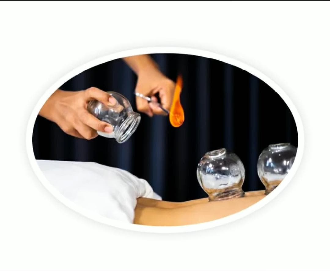 Cupping Therapy in All Its Forms