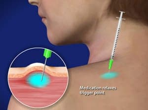 Trigger Point Injection Therapy