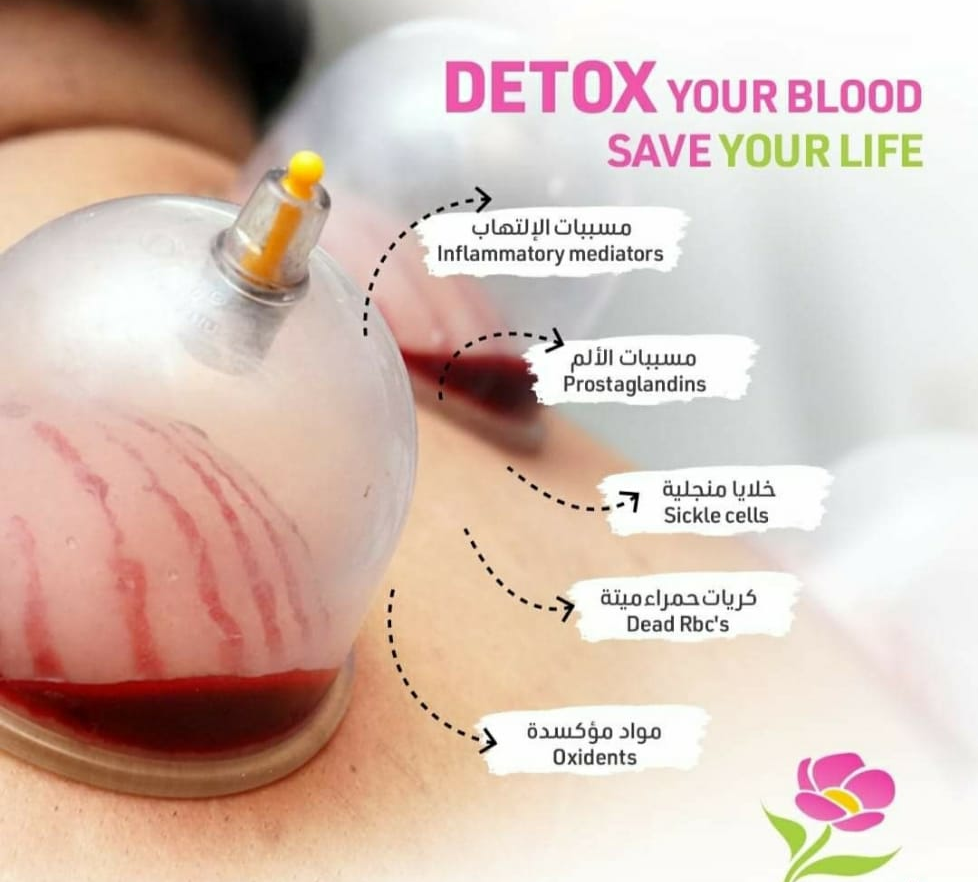 Hijama